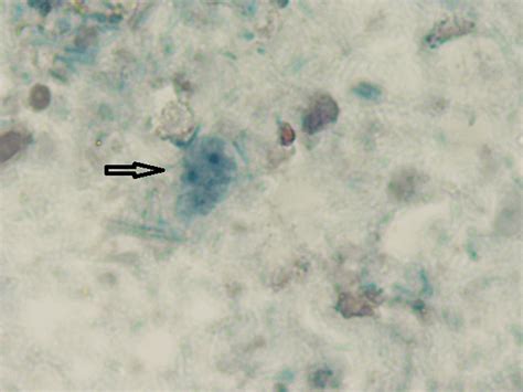  Dientamoeba Fragilis: This Microscopic Intruder Can Sneak Into Your Gut Without You Ever Knowing!